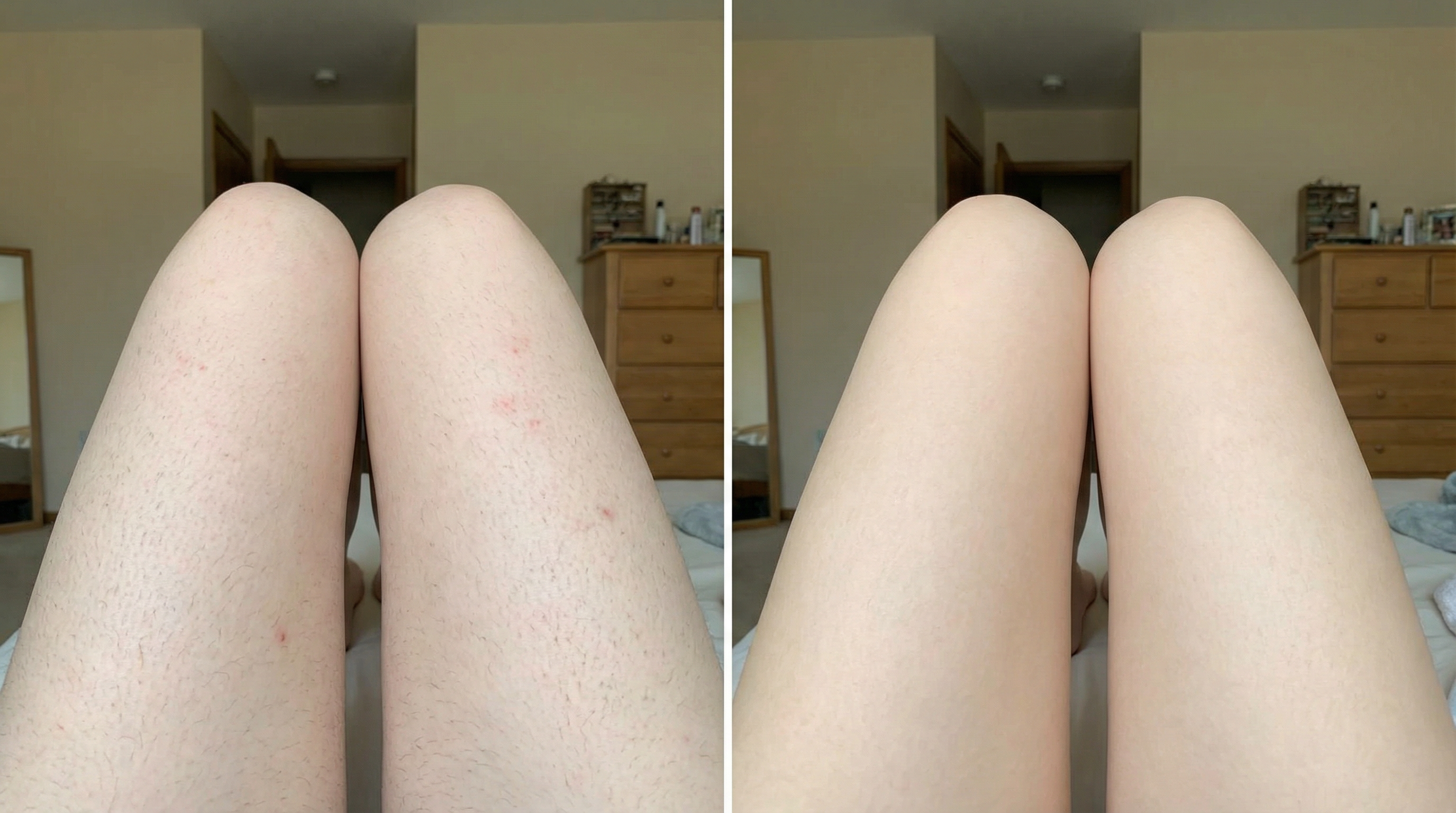 Before and After - Full Legs treatment