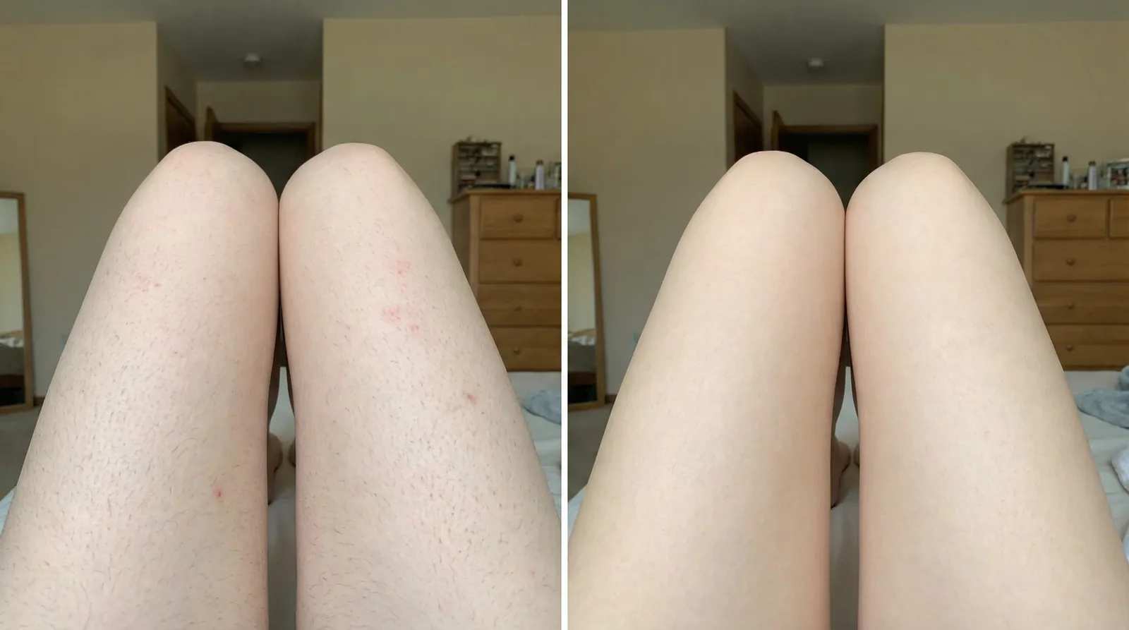 Before and After - Full Legs treatment